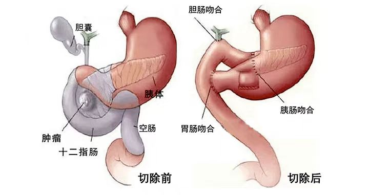 陕西省核工业二一五医院应用磁牵引术野暴露系统完成咸阳区域首例胰十二指肠切除手术